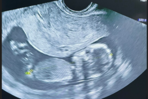 Ultrasonid Ultrasonid